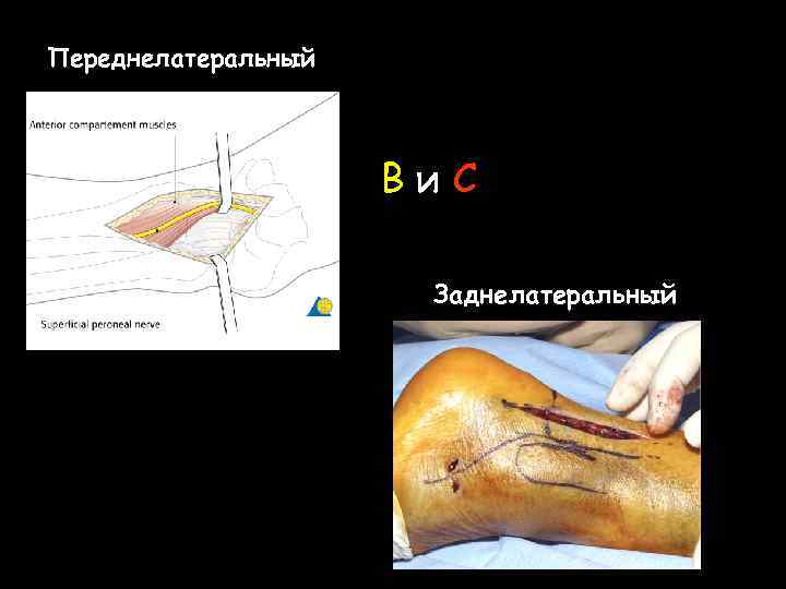 Переднелатеральный Ви. С Заднелатеральный 
