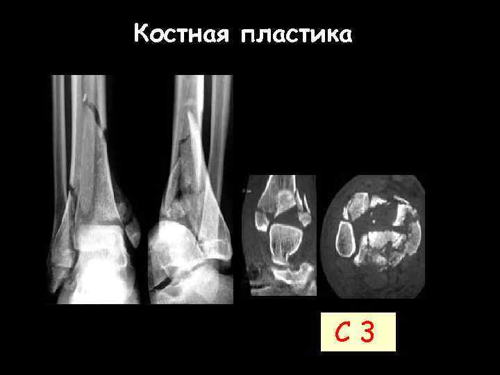 Костную пластику. Костная пластика в ортопедии. Костная пластика в травматологии и ортопедии. Остеопластика в травматологии. Наращивание кости в травматологии.