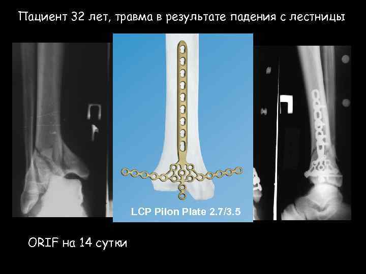 Пациент 32 лет, травма в результате падения с лестницы LCP Pilon Plate 2. 7/3.