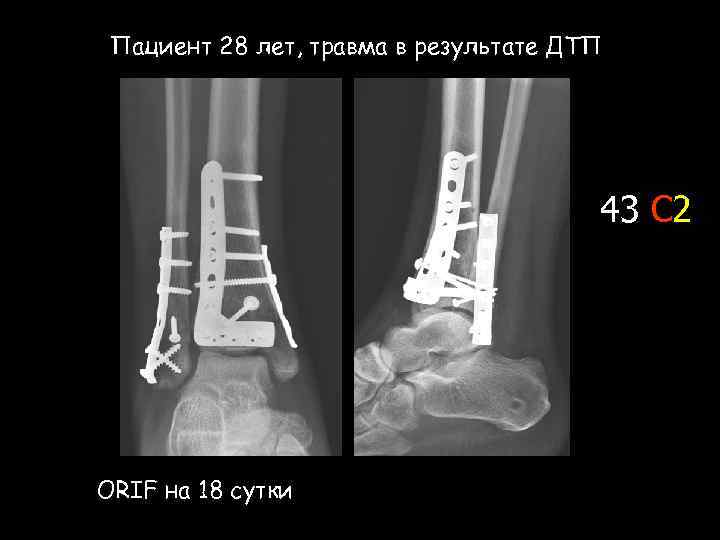 Пациент 28 лет, травма в результате ДТП 43 С 2 ОRIF на 18 сутки
