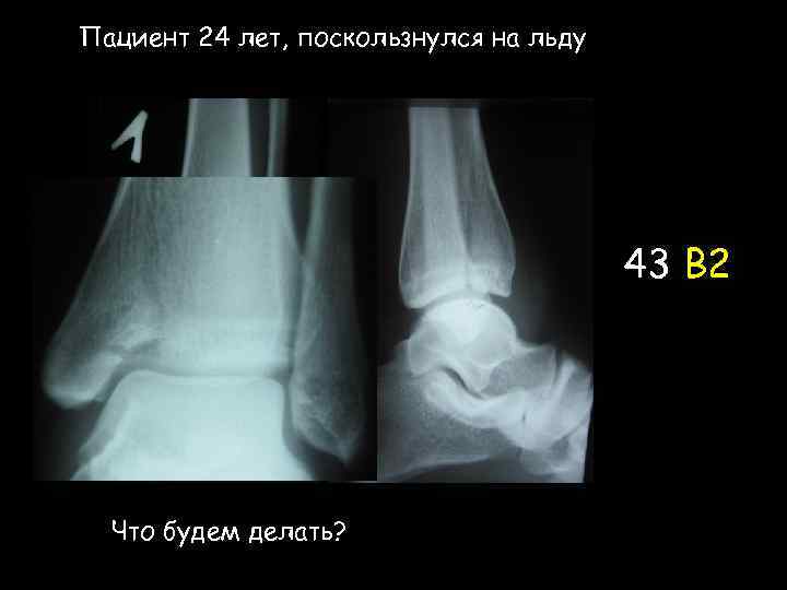 Пациент 24 лет, поскользнулся на льду 43 В 2 Что будем делать? 