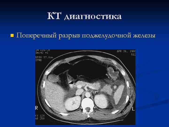 КТ диагностика n Поперечный разрыв поджелудочной железы 