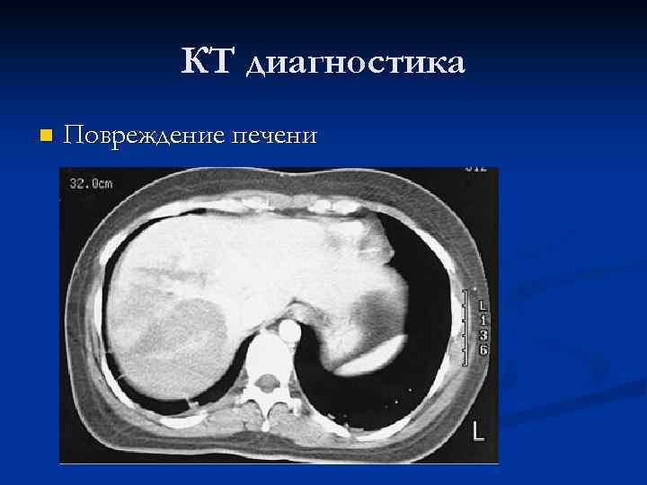 КТ диагностика n Повреждение печени 