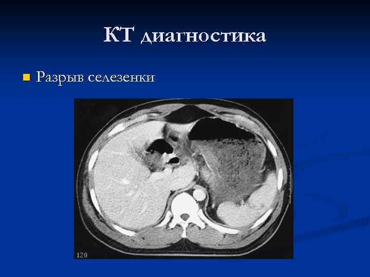КТ диагностика n Разрыв селезенки 