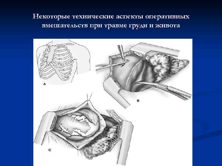 Некоторые технические аспекты оперативных вмешательств при травме груди и живота 
