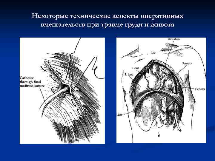 Некоторые технические аспекты оперативных вмешательств при травме груди и живота 