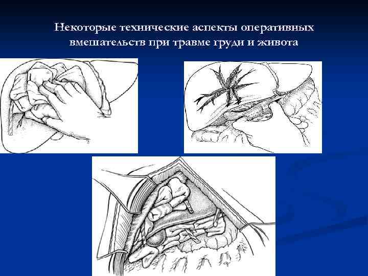 Некоторые технические аспекты оперативных вмешательств при травме груди и живота 
