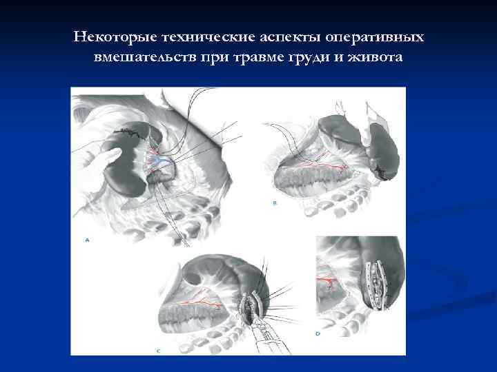 Некоторые технические аспекты оперативных вмешательств при травме груди и живота 