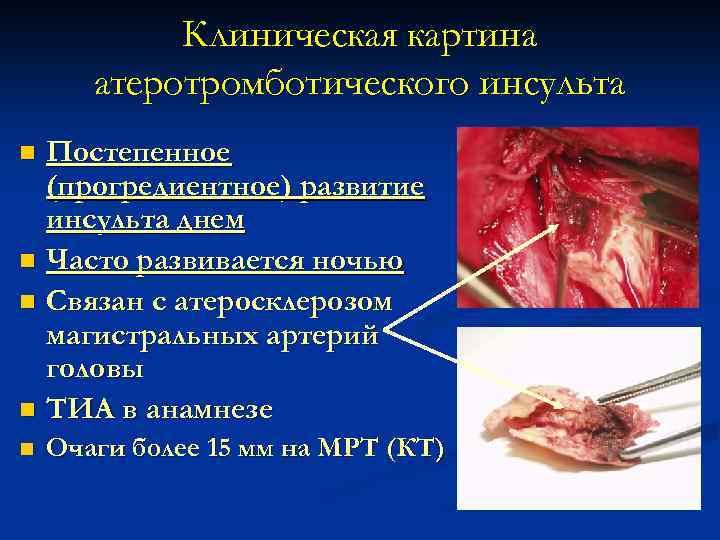 Клиническая картина атеротромботического инсульта n Постепенное (прогредиентное) развитие инсульта днем Часто развивается ночью Связан