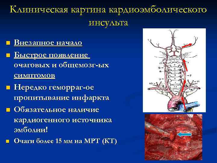 Клиническая картина кардиоэмболического инсульта n n n Внезапное начало Быстрое появление очаговых и общемозг-ых