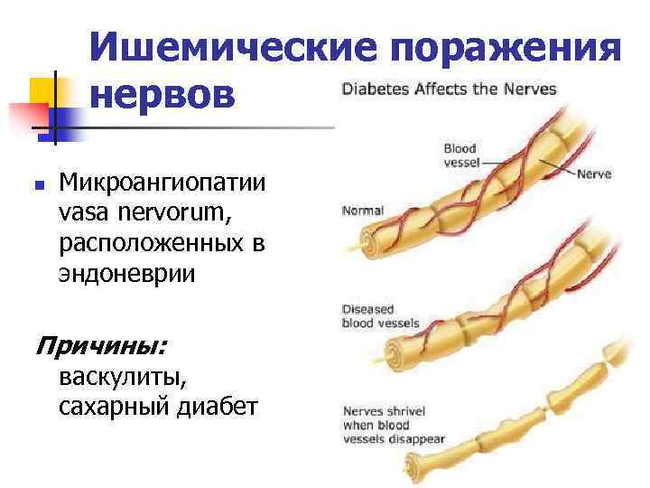 Мр картина единичных супратенториальных очагов глиоза микроангиопатия