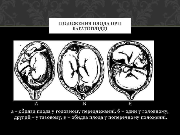 ПОЛОЖЕННЯ ПЛОДА ПРИ БАГАТОПЛІДДІ А Б В а – обидва плода у головному передлежанні,