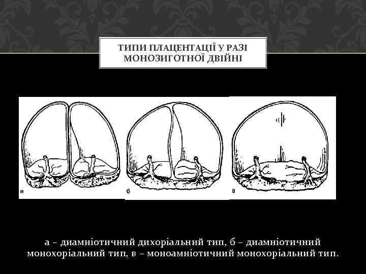 ТИПИ ПЛАЦЕНТАЦІЇ У РАЗІ МОНОЗИГОТНОЇ ДВІЙНІ а – диамніотичний дихоріальний тип, б – диамніотичний