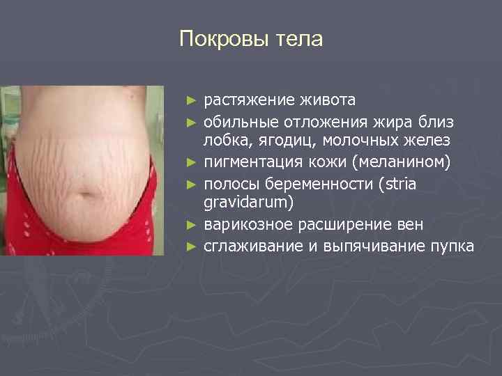 Покровы тела растяжение живота ► обильные отложения жира близ лобка, ягодиц, молочных желез ►
