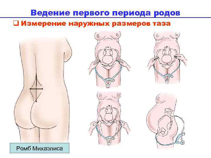 Ведение первого периода родов q Измерение наружных размеров таза Ромб Михаэлиса 