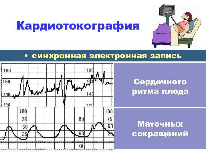 Кардиотокография • синхронная электронная запись Сердечного ритма плода Маточных сокращений 