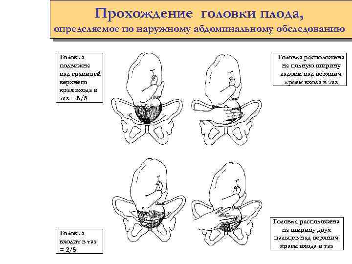 Прохождение головки плода, определяемое по наружному абдоминальному обследованию Головка подвижна над границей верхнего края