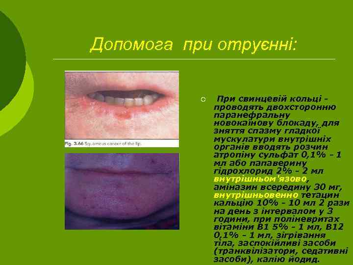 Допомога при отруєнні: ¡ При свинцевій кольці - проводять двохсторонню паранефральну новокаїнову блокаду, для