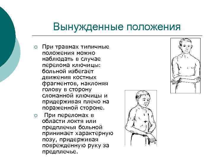 Вынужденные положения ¡ ¡ При травмах типичные положения можно наблюдать в случае перелома ключицы: