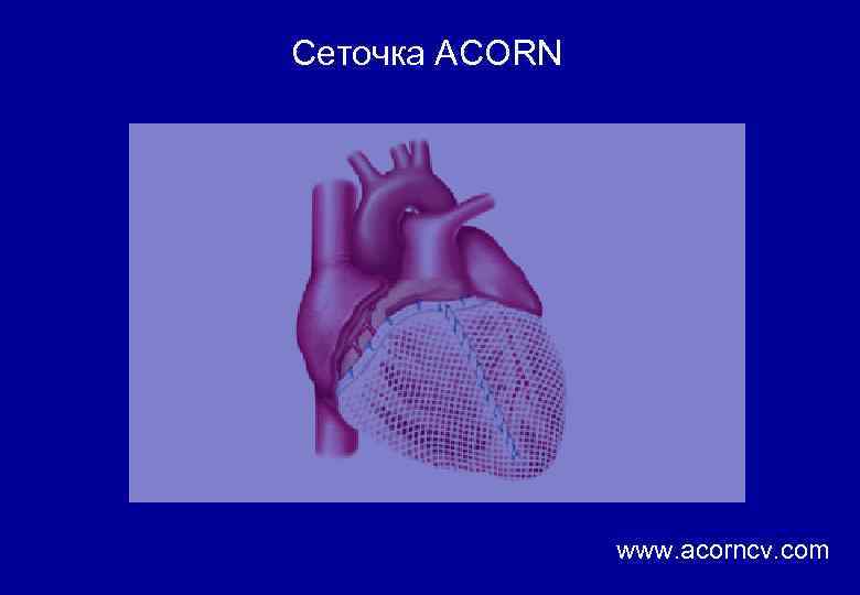 Сеточка ACORN www. acorncv. com 