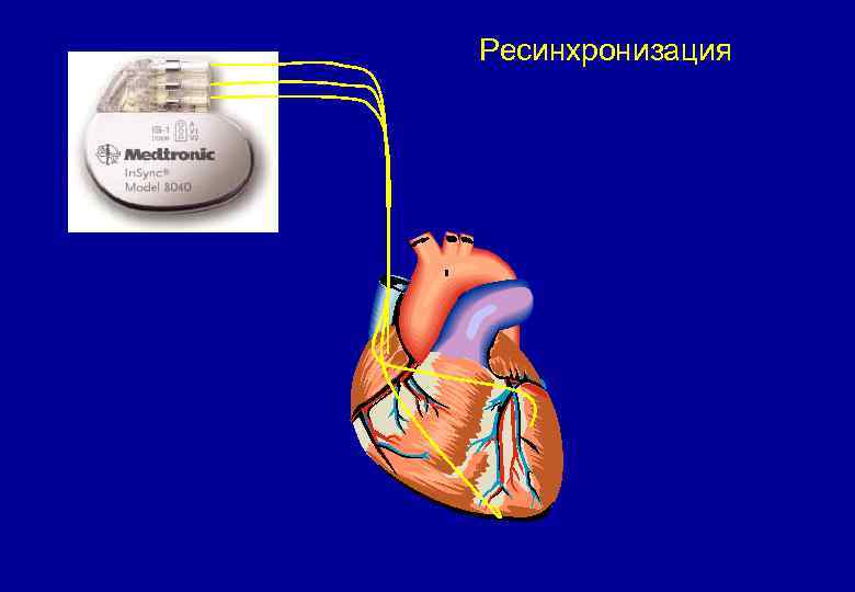 Ресинхронизация 