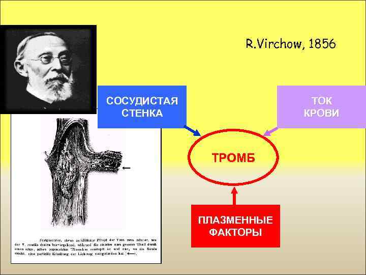 R. Virchow, 1856 СОСУДИСТАЯ СТЕНКА ТОК КРОВИ ТРОМБ ПЛАЗМЕННЫЕ ФАКТОРЫ 