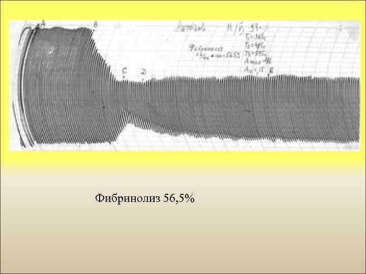 Фибринолиз 56, 5% 