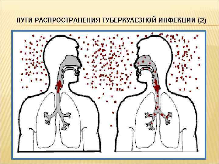 Перечислите пути распространения инфекции вызывающей спид. Пути распространения туберкулезной инфекции. Воздушно-капельный путь передачи инфекции.