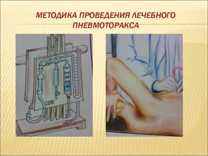 МЕТОДИКА ПРОВЕДЕНИЯ ЛЕЧЕБНОГО ПНЕВМОТОРАКСА 