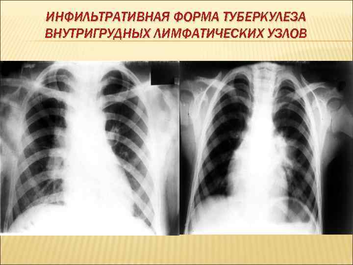 ИНФИЛЬТРАТИВНАЯ ФОРМА ТУБЕРКУЛЕЗА ВНУТРИГРУДНЫХ ЛИМФАТИЧЕСКИХ УЗЛОВ 