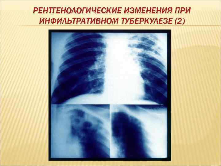 РЕНТГЕНОЛОГИЧЕСКИЕ ИЗМЕНЕНИЯ ПРИ ИНФИЛЬТРАТИВНОМ ТУБЕРКУЛЕЗЕ (2) 