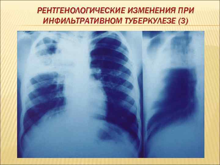 РЕНТГЕНОЛОГИЧЕСКИЕ ИЗМЕНЕНИЯ ПРИ ИНФИЛЬТРАТИВНОМ ТУБЕРКУЛЕЗЕ (3) 