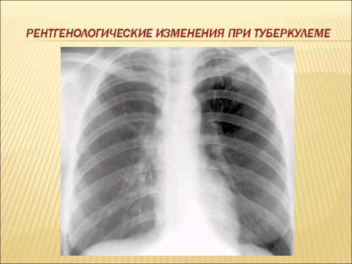 РЕНТГЕНОЛОГИЧЕСКИЕ ИЗМЕНЕНИЯ ПРИ ТУБЕРКУЛЕМЕ 