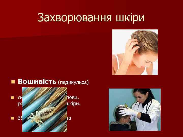 Захворювання шкіри n Вошивість (педикульоз) n сильний свербіж голови, розчухи, запалення шкіри. n Збудник-головна