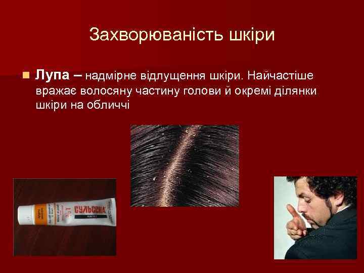 Захворюваність шкіри n Лупа – надмірне відлущення шкіри. Найчастіше вражає волосяну частину голови й
