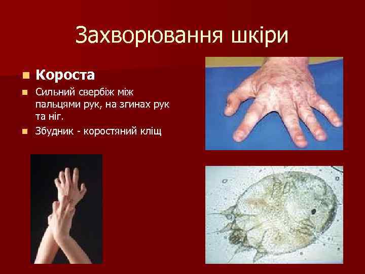 Захворювання шкіри n Короста Сильний свербіж між пальцями рук, на згинах рук та ніг.