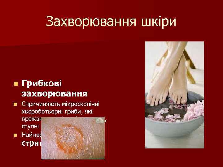 Захворювання шкіри n Грибкові захворювання Спричиняють мікроскопічні хвороботворні гриби, які вражають нігті, шкіру голови,
