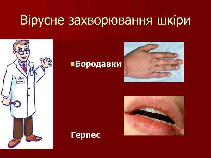 Вірусне захворювання шкіри n. Бородавки n n Герпес 
