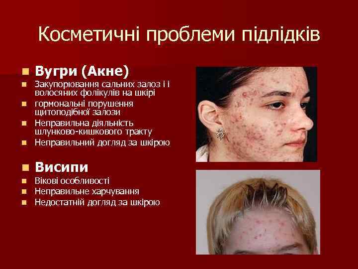 Косметичні проблеми підлідків n Вугри (Акне) n Закупорювання сальних залоз і і волосяних фолікулів