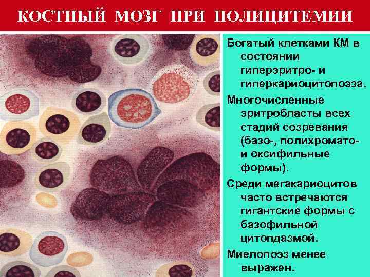 КОСТНЫЙ МОЗГ ПРИ ПОЛИЦИТЕМИИ Богатый клетками КМ в состоянии гиперэритро- и гиперкариоцитопоэза. Многочисленные эритробласты