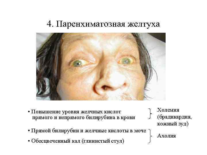 4. Паренхиматозная желтуха • Повышение уровня желчных кислот прямого и непрямого билирубина в крови
