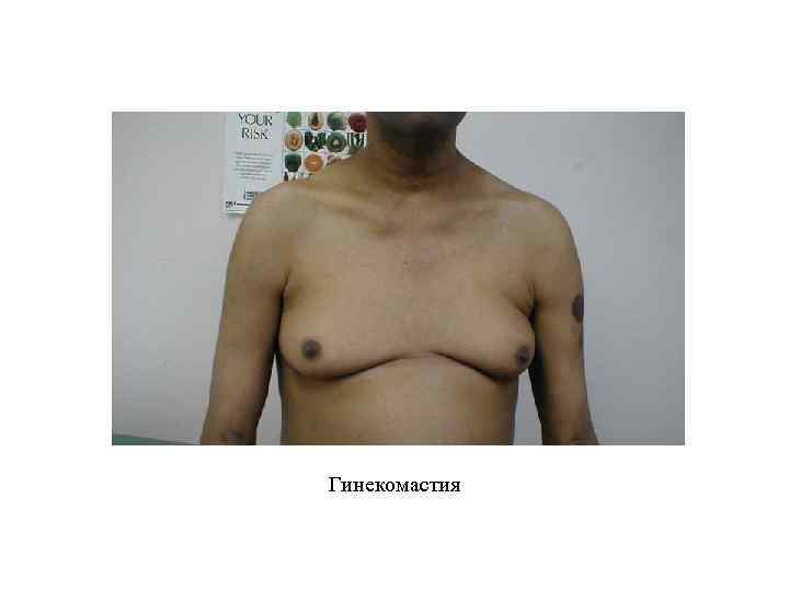 Гинекомастия 