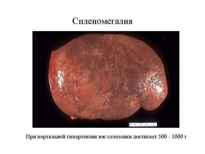 Спленомегалия При портальной гипертензии вес селезенки достигает 500 - 1000 г 