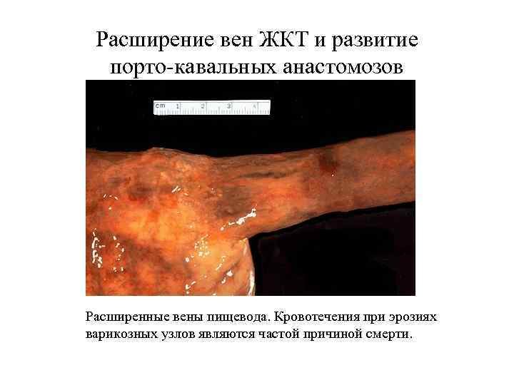 Расширение вен ЖКТ и развитие порто-кавальных анастомозов Расширенные вены пищевода. Кровотечения при эрозиях варикозных