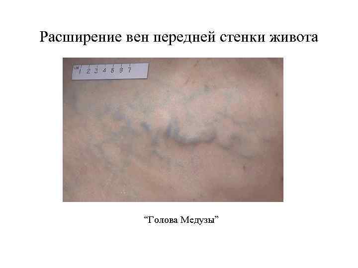 Расширение вен передней стенки живота “Голова Медузы” 