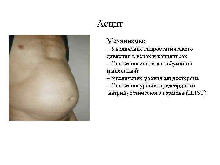 Асцит Механизмы: – Увеличение гидростатического давления в венах и капиллярах – Снижение синтеза альбуминов