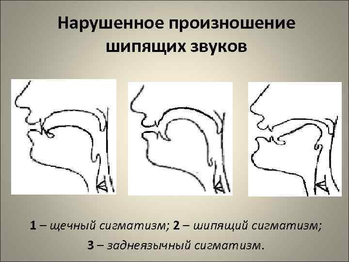 Нарушенное произношение шипящих звуков 1 – щечный сигматизм; 2 – шипящий сигматизм; 3 –