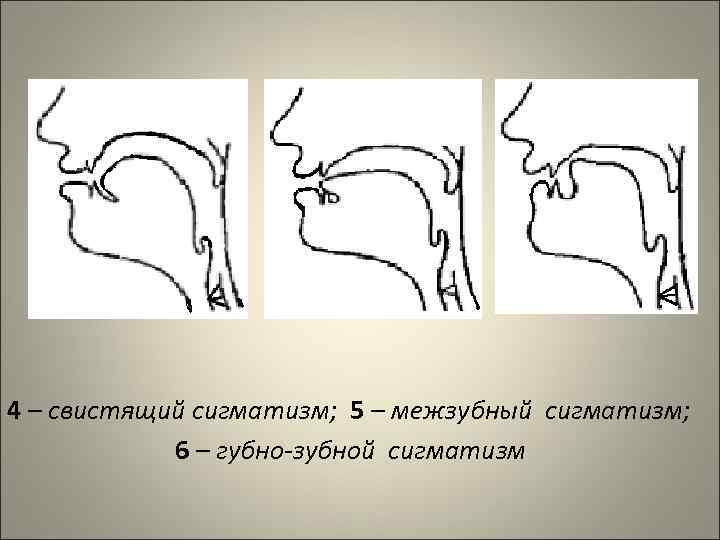 4 – свистящий сигматизм; 5 – межзубный сигматизм; 6 – губно-зубной сигматизм 