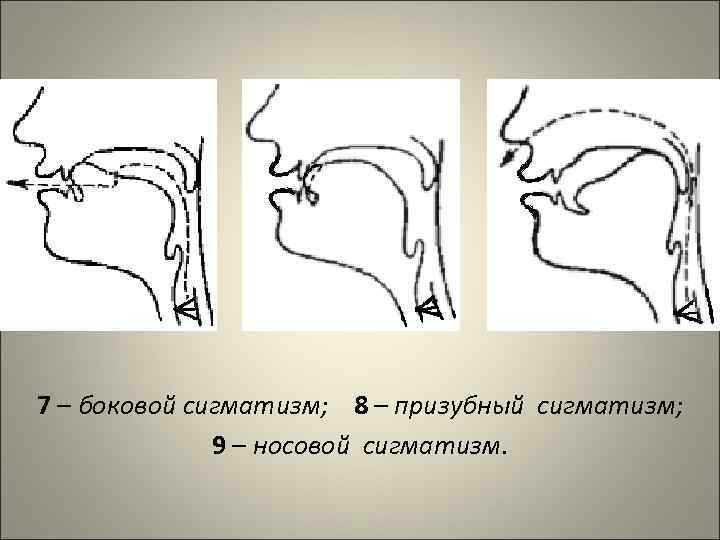 7 – боковой сигматизм; 8 – призубный сигматизм; 9 – носовой сигматизм. 