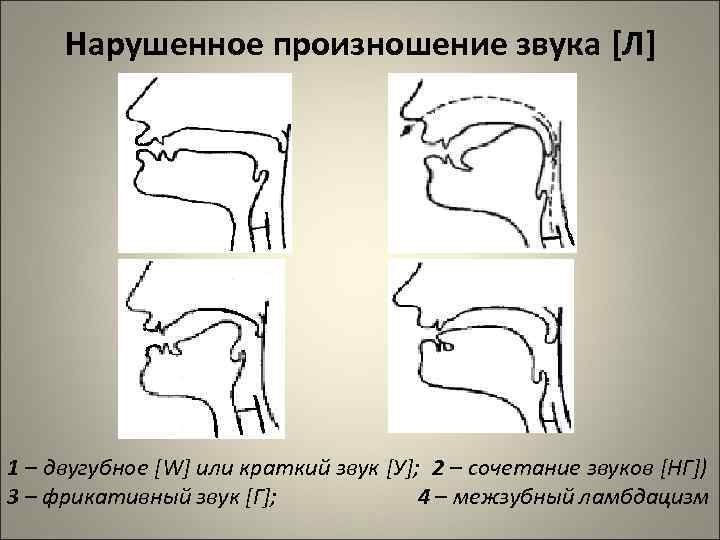 Нарушенное произношение звука [Л] 1 – двугубное [W] или краткий звук [У]; 2 –